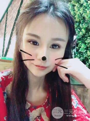 芭比雙眼皮多項整形前后對比照片 青島諾德曹繼武雙眼皮案例