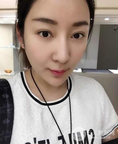 全臉線D圖片 線D恢復過程圖片