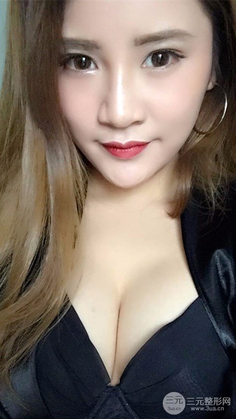 淄博陽光整形自體脂肪隆胸前后對比圖，真實案例