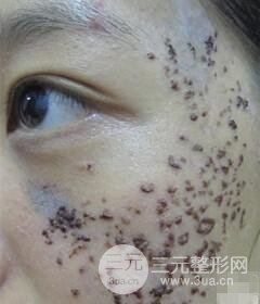 南寧緩解的太田痣真實案例,前后果對比圖