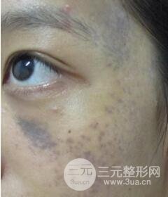 南寧緩解的太田痣真實案例,前后果對比圖