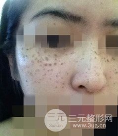 激光祛斑的恢復(fù)過程，逐步見證自己顏值的逐步提升。