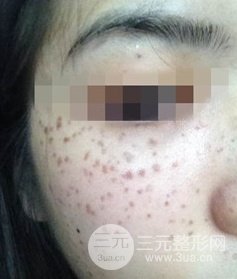 激光祛斑的恢復(fù)過程，逐步見證自己顏值的逐步提升。