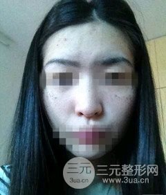 激光祛斑的恢復(fù)過程，逐步見證自己顏值的逐步提升。