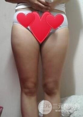 全身吸脂減肥前后對(duì)比圖和恢復(fù)過程真實(shí)案例分享