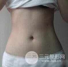 全身吸脂減肥前后對(duì)比圖和恢復(fù)過程真實(shí)案例分享