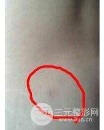 全身吸脂減肥前后對(duì)比圖和恢復(fù)過程真實(shí)案例分享