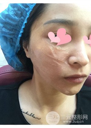 高強度聚焦超聲手術(shù)前后過程以及真實案例分享——廈門思明安黛美林韻醫(yī)生做的