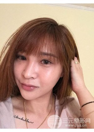 高強度聚焦超聲手術(shù)前后過程以及真實案例分享——廈門思明安黛美林韻醫(yī)生做的