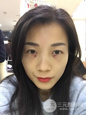 分享我的激光祛眼袋手術(shù)前后過程，廈門思明安黛美林韻醫(yī)生做的