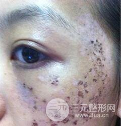 做了三次激光去太田痣，后來的果已經(jīng)是我較為滿意的了。