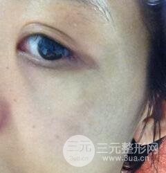 做了三次激光去太田痣，后來的果已經(jīng)是我較為滿意的了。