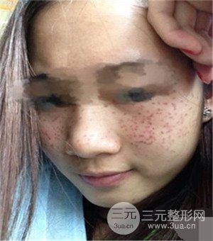 面部美白容整形激光祛斑手術(shù)恢復(fù)過(guò)程