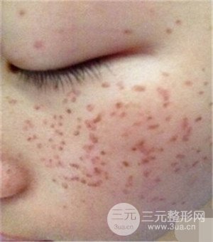 面部美白容整形激光祛斑手術(shù)恢復(fù)過(guò)程