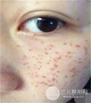 面部美白容整形激光祛斑手術(shù)恢復(fù)過(guò)程