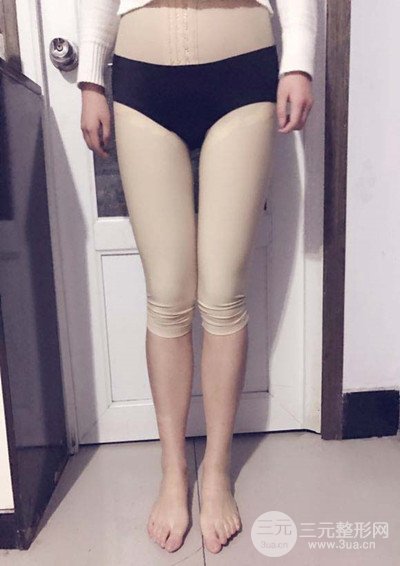 大腿抽脂真實過程圖，輕松擁有細長雙腿