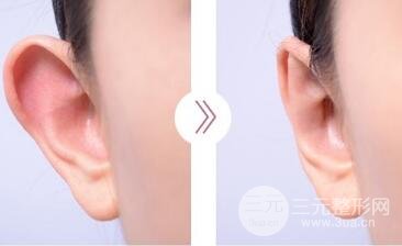 招風耳整形手術(shù)多少錢?矯正果圖
