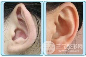招風(fēng)耳矯正好不好?會(huì)不會(huì)留疤?