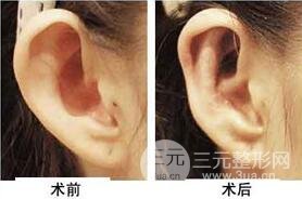 招風(fēng)耳矯正好不好?會(huì)不會(huì)留疤?