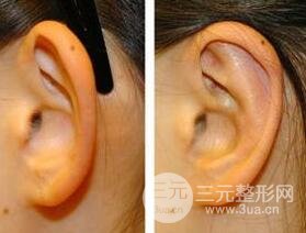 招風耳矯正圖片，招風耳矯正整形價格介紹