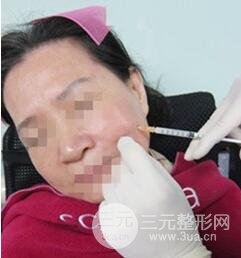 自從打了膠原蛋白除皺以后，都說我年輕多了