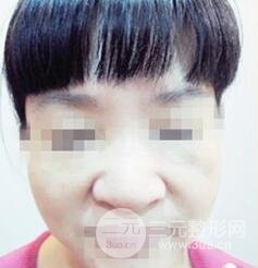 自從打了膠原蛋白除皺以后，都說我年輕多了