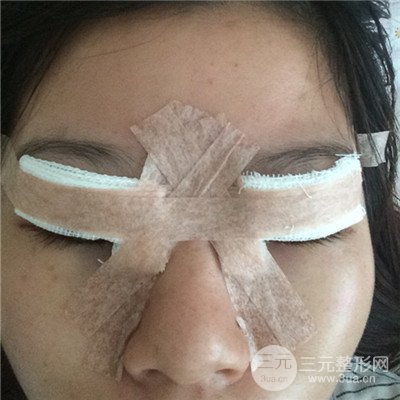 濟(jì)南曹博士美容醫(yī)院曹景敏眼部綜合整形真人案例分享