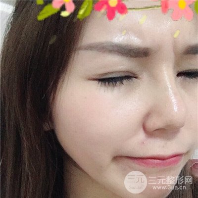 濟(jì)南曹博士美容醫(yī)院曹景敏眼部綜合整形真人案例分享