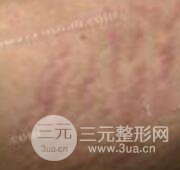 果酸換膚去妊娠紋真人案例和妊娠紋整形手術(shù)前后對比圖