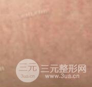 果酸換膚去妊娠紋真人案例和妊娠紋整形手術(shù)前后對比圖