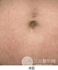 果酸換膚去妊娠紋真人案例和妊娠紋整形手術(shù)前后對比圖