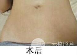 如何去除妊娠紋？做了果酸換膚去妊娠紋果不錯，真人案例圖片分享