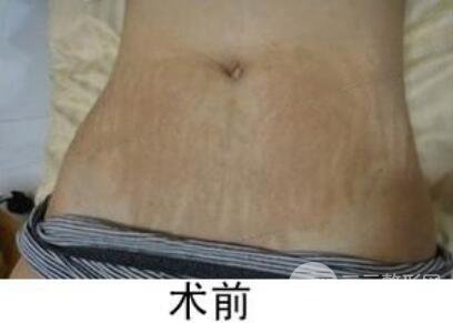 如何去除妊娠紋？做了果酸換膚去妊娠紋果不錯，真人案例圖片分享