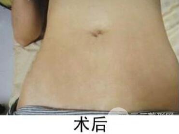 如何去除妊娠紋？做了果酸換膚去妊娠紋果不錯，真人案例圖片分享