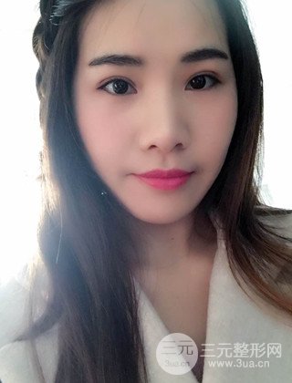 漢中韓美切開(kāi)雙眼皮開(kāi)眼角恢復(fù)對(duì)比照片