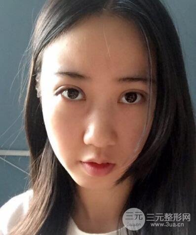 埋線雙眼皮真人案例和十天恢復(fù)圖片日記