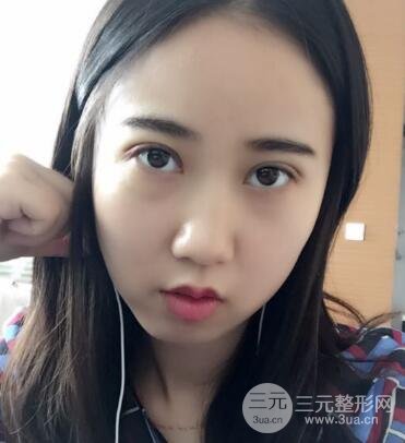 埋線雙眼皮真人案例和十天恢復(fù)圖片日記