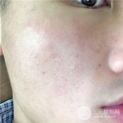 濟南曹博士魯開化祛痘坑痘印真人案例分享