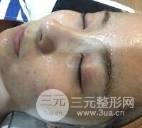 水光補水嫩膚果圖前后對比和恢復(fù)過程真實案例分享