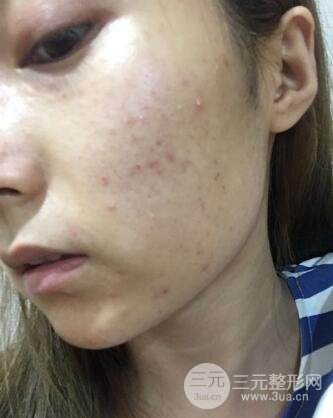 水光補(bǔ)水嫩膚果圖前后對比和恢復(fù)過程真實(shí)案例分享