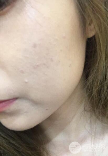 水光補(bǔ)水嫩膚果圖前后對比和恢復(fù)過程真實(shí)案例分享