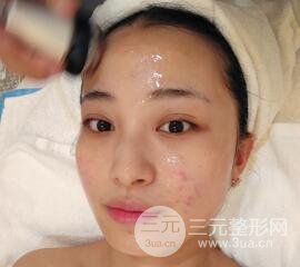 痘坑痘疤要怎么修復(fù)？果酸換膚后臉果圖和真實案例分享