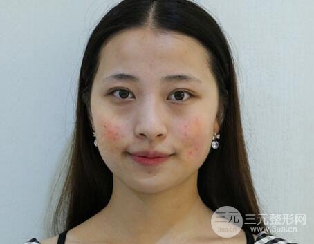 痘坑痘疤要怎么修復(fù)？果酸換膚后臉果圖和真實(shí)案例分享