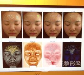 痘坑痘疤要怎么修復(fù)？果酸換膚后臉果圖和真實(shí)案例分享