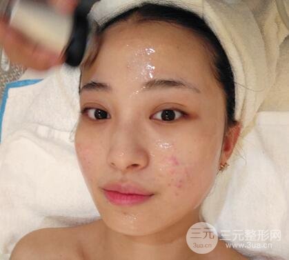痘坑痘疤要怎么修復(fù)？果酸換膚后臉果圖和真實(shí)案例分享