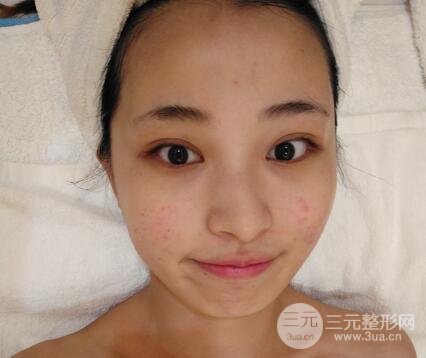 痘坑痘疤要怎么修復(fù)？果酸換膚后臉果圖和真實(shí)案例分享