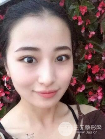 痘坑痘疤要怎么修復(fù)？果酸換膚后臉果圖和真實(shí)案例分享