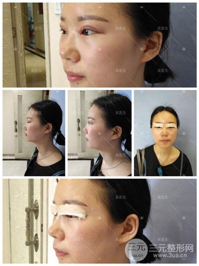 武漢卓美吳秀英雙眼皮+開眼角一個(gè)月恢復(fù)對(duì)比照片分享~