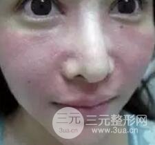 我做了光子嫩膚幾天起而且價(jià)格便宜前后對(duì)比照片案例