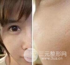 我做了光子嫩膚幾天起而且價(jià)格便宜前后對(duì)比照片案例